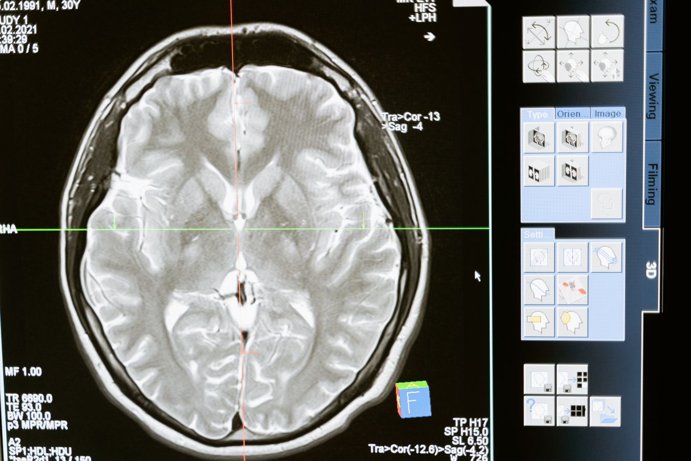 brain scan imaging used in traumatic brain injury claim